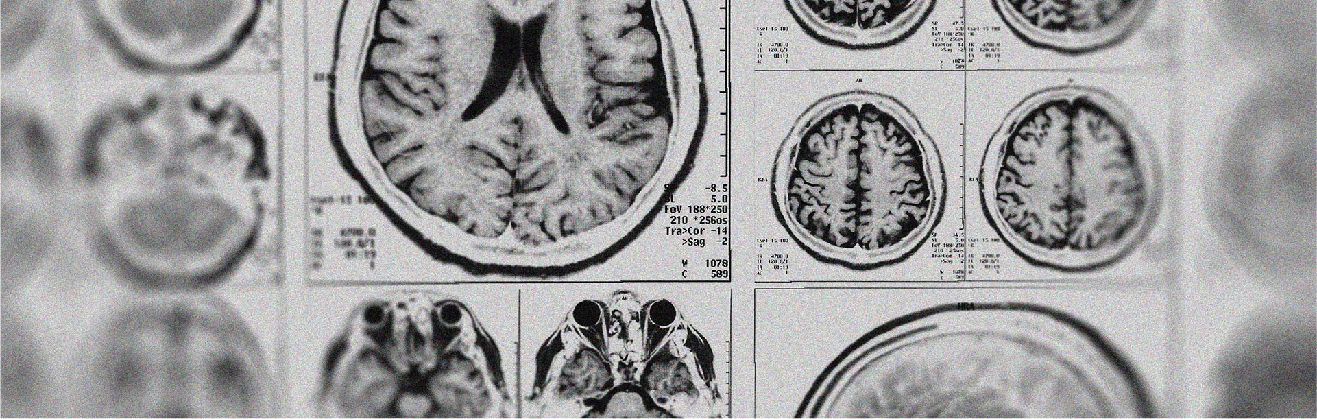Discover whether melatonin has a neuroprotective effect