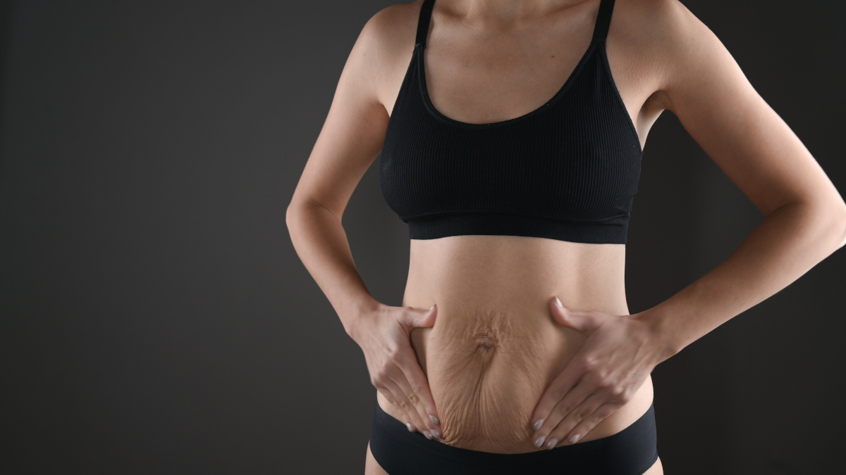 Post-childbirth belly